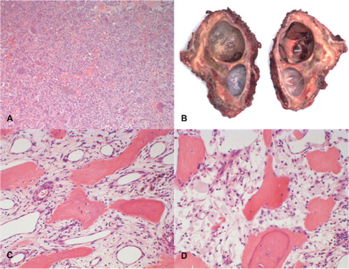 Figure 3. A. Histology of the biopsy specimen before the start of denosumab treatment showed numerous uniformly spaced giant cells with large vesicular nuclei, prominent nucleoli, and mononuclear cells with eosinophilic cytoplasm and nuclei similar to those of adjacent giant cells, which is consistent with the diagnosis of GCTB. B. Macro specimen of intralesional resection after 7 months of treatment with denosumab, showing 2 large cysts and focal clots. The resection planes were not free of reactive tissue. C and D. Histology of the surgical specimen showed stromal cells, scattered mononuclear spindle cells with elongated oval-shaped nuclei without evident atypia, and diffuse foamy macrophages. No multinucleated giant cells were seen.