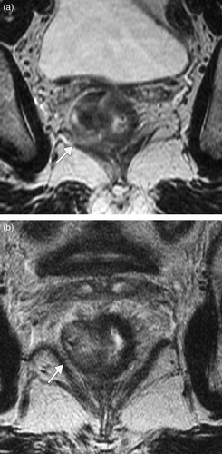 Figure 5.  Oblique axial T2 weighted MRI through a low rectal tumour in a different patient (a) before and (b) after short course radiotherapy. (a) Tumour is seen to abut, possibly invade the right levator plate initially (arrow) with an ‘at risk’ crm. (b) Following short course radiotherapy there is a clear fat plane between the tumour (with intact muscle layer) and the levator muscle (arrow) and the crm is preserved.