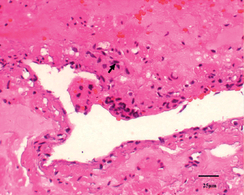 Figure 3. Coagulative necrosis is characterized by indistinct cellular detail with relatively preserved tissue structure, including pyknotic to karyorectic nuclei and shrunken hypereosinophilic cytoplasm (↑).