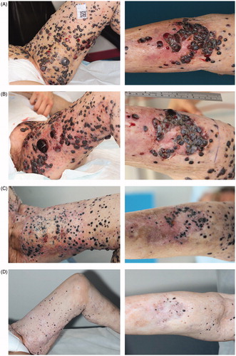 Figure 1. Images of left thigh and left calf, over time. (A) February 2015, before electrochemotherapy. Cutaneous metastases extended from the left side of the abdomen to the left calf, with bleeding lesions. (B) March 2015, the day after treatment with electrochemotherapy. The treated areas include the front and back of her thigh, 20 × 25 cm and 30 × 13 cm, respectively, and on the back of her calf 20 × 10 cm. The areas are marked with pen and appear erythematous. The bleeding has stopped and the metastases appear pale. (C) May 2015, two months after treatment with electrochemotherapy, leveling of the cutaneous metastases in the treated area, the lesions appear more pale and as scars, from where exophytic lesions have fallen off, are visible. (D) July 2016, 12 months after retreatment with calcium and electroporation and 16 months after the first electrochemotherapy, complete leveling of all cutaneous metastases and appearance of vitiligo in both treated and untreated area. Biopsies from pigmented lesions were without malignancy (see supplementary Figure 1).