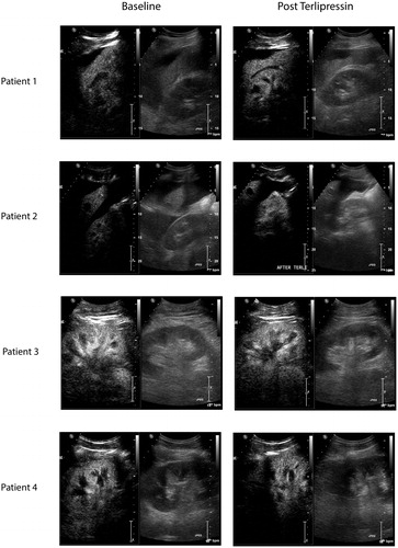 Figure 2. Screenshot of CEUS images. Left side of the panel: images obtained at baseline; right side of the panel images obtained 2 h after intravenous administration of 1 mg terlipressin. Each image is divided into two (left side: contrast-enhanced image and right side: conventional “B mode” ultrasound image for orientation).