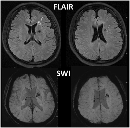 Figure 5. In this patient who sustained a mTBI, MRI studies performed more than 1 year post-injury show areas of hemosiderin deposition as numerous chronic haemorrhagic lesions (multifocal hypointense regions of dark signal). Note, in association with the hemosiderin depositions are scattered white matter hyper-intense signal abnormalities (white arrows).
