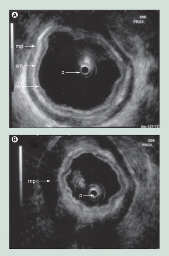 Figure 5. Gastric contraction demonstrated by intraluminal ultrasonography.(A) An ultrasound miniprobe (p) is placed in the relaxed water-filled antral part of the stomach. (B) A contraction with thickening of the mp is seen.m: Mucosa; mp: Muscularis propria; p: Probe; sm: Submucosa. Reproduced with permission from Citation[56].