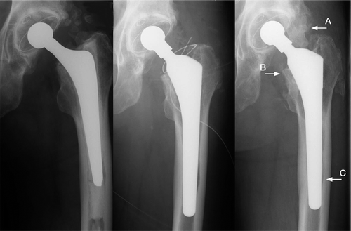 Figure 2. Remodeling changes around the stem. Arrows indicate heterotopic ossi.cation (A), calcar round-off (B), and regression of osteolysis (C).
