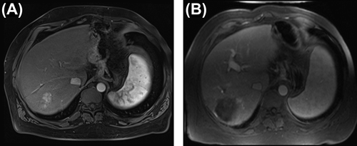 Figure 1. MR imaging of HCC. A: Pre-treatment. A solitary enhancing HCC is present in the right lobe. B: Post-transarterial chemoembolization. The HCC has been successfully treated, and there is an absence of viable tumor despite an increase in size of lesion.