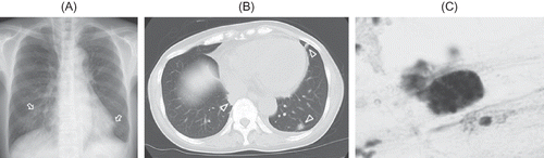 Figure 1. (A) Chest radiograph showing a few small obscure nodular shadows in bilateral lung (arrows). (B) Chest computed tomography examination showing multiple nodules (arrow heads). (C) Macrophages phagocytizing hemosiderin by cytology of broncho-alveolar lavage.