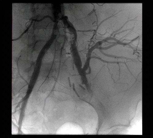 Figure 1. Aortogram with flush catheter in distal abdominal aorta demonstrating terminal aortic occlusive disease.