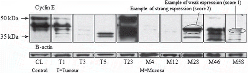 Figure 2. Cyklin E expression in tumor and mucosa as both FL-form (50kDa) and LMW-isoform (35kDa). Examples of expression strength scoring is also shown.