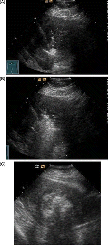 Figure 2. (A) The ultrasound image of 2D grey-scale of uterus myoma at 10 s after MW therapy. Echo enhancement began around the antennas. (B) Ultrasound image of 2D grey-scale of uterus myoma at 70 s after MW therapy. The area of echogenicity is noted to be enlarged. (C) Ultrasound image of 2D grey-scale of uterus myoma at the end of ablation. The whole myoma is obscured due to echoes.