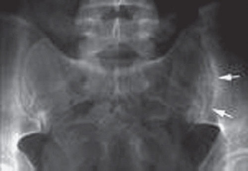 Figure 1. X-ray showing sacroiliitis.