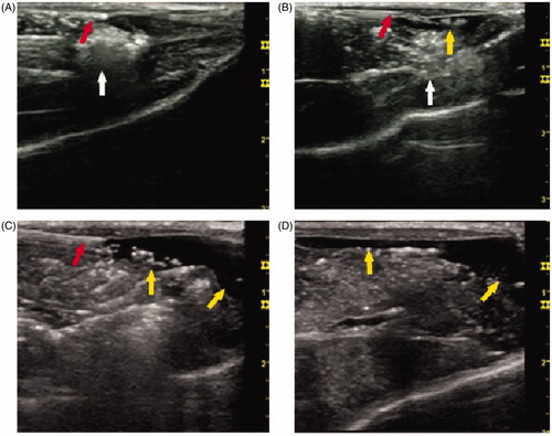 Figure 2. Ultrasonography during the RF ablative procedure. Representative images of grey-scale ultrasonography during the RF ablative procedure. (A) The position of the ablative zone and the thermal sensor. (B) The position of the ablative zone and the needle for injection. (C) Distribution of the solution injected in the pre-injection group. (D) Distribution of the solution injected in the perfusion group. The thermal sensor and the needle for injection are viewed as an echogenic line (red arrow). The ablative zone is viewed as an echogenic area (white arrow). The solution injected subcutaneously is viewed as a no-echo region (yellow arrow) with a significantly uneven distribution (54 × 50 mm, 300 × 300 dpi).