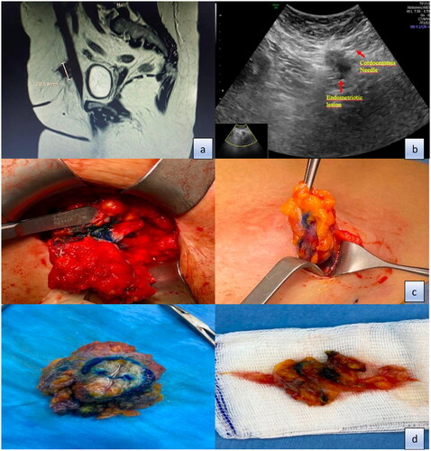 Figure 1. (a) MRI imaging of subcutaneous endometriotic lesion. (b) Administering methylene blue to the lesion with the help of a cordocentesis needle under the guidance of transabdominal USG. (c) Detection of lesions stained with methylene blue. (d) Image of endometriotic lesions after removal with 1 cm of intact tissue.