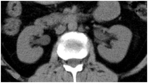 Figure 2. Difference of the renal pelvis angle from right to the left side.