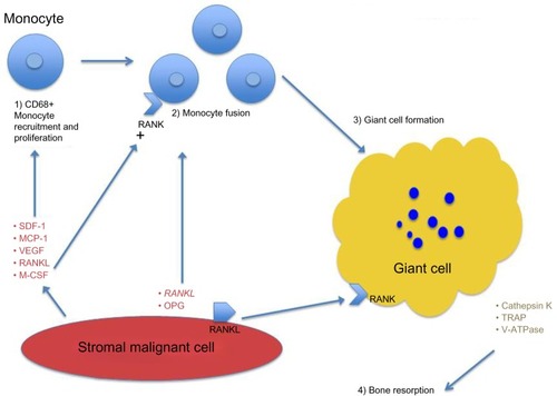 Figure 1 Pathophysiology of giant-cell tumor of bone.