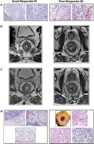 Figure 1. Tumor histology and MRI specimens – exemplified by Good-Responder #1 and Poor-Responder #2. (a) Diagnostic tumor biopsies, each in two magnifications, from rectum displaying SRCC differentiation. (b) Diagnostic MRI scans, axial and T2-weighted images, illustrating rectal tumors with SRCC signal pattern. (c) Preoperative MRI scans, axial and T2-weighted images, illustrating rectal tumors with SRCC signal pattern. (d) Surgical specimens, in several magnifications, depicting treatment responses.