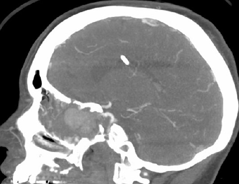 Figure 11 Sagittal view of the head CT with contrast showing a pseudoaneurysm of the cavernous portion of the right internal carotid artery protruding into the ethmoidal sinus.