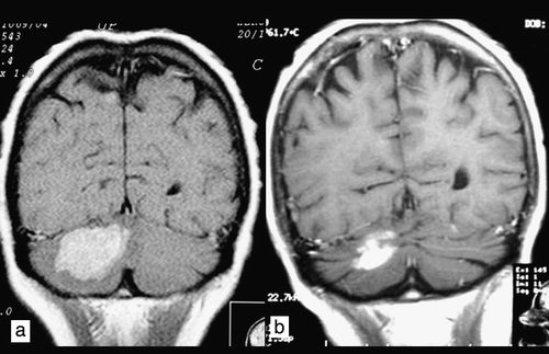 Figure 2.  Coronal T1W contrast-enhanced image. Patient 2. a) Magnetic resonance imaging scan of occult multiple subtentorial and supratentorial metastases before radiotherapy. b) Partial remission 3 months after whole-brain radiotherapy.