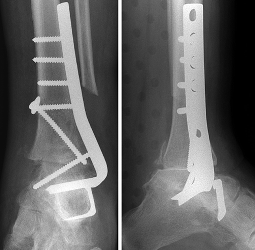 Figure 3. Postoperatively, the pantalar arthrodesis and removal of the posterior talar process.