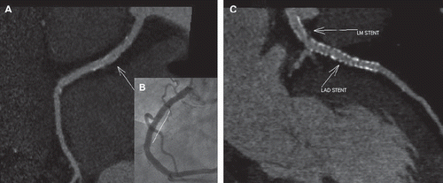 Figure 1. (A) CCTA of RCA showing widely patent mid RCA stent with minimal blooming artifact (site of stent denoted by arrow); image generated with a sharp kernel (B46f, Heartview, Siemens). (B) ICA of mid RCA post stenting (white line denoting site of stent). (C) CCTA of left coronary system showing stents in LM and LAD with some blooming artifact (site of stents denoted by arrow); image generated with a sharp kernel (B46f, Heartview, Siemens).