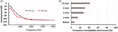 Figure 22. Preoperative and postoperative audiograms showing the mean hearing level for each frequency for the CI implanted group (A). Monosyllable scores overtime under the noisy condition for patients with PD. Graph and histogram created from data given in Skarzynski et al. [Citation18].