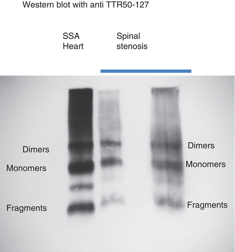 Figure 4. Western blot analysis of extracts of two spinal stenosis materials, positive for transthyretin at immunohistochemistry. Included is also an extract of amyloid fibrils obtained from the heart of a patient with senile systemic amyloidosis. The pattern is the same in all three materials with full-length transthyretin as well as a prominent band corresponding to C-terminal fragments. The unlabeled band between monomers and dimers has constantly been found in senile systemic amyloidosis and may be dimers of fragments.