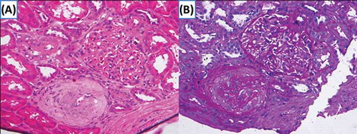 Figure 1. Renal biopsy with histological staining [(A) hematoxylin–eosin, ×200; (B) periodic acid-Schiff, ×200] showed features consistent with CIN. Glomeruli displayed focal necrosis in some areas, cells with pyknotic nuclei, and an increase in thickness of basal membrane of intraglomerular capillary. Examination of the tubulointerstitial space revealed diffuse tubular atrophy with epithelial cell desquamation and necrosis.