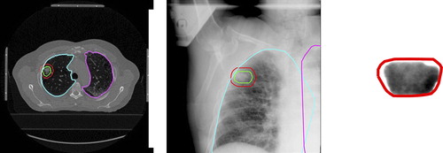 Figure 1. Representative example of the patient dataset for one of the patients with delineated structures from the planning phase. a) shows a planning CT slice with left (cyan) and right (magenta) lungs, the CTV (green) and the PTV (red), b) shows a kV x-ray with the planning structures projected, and c) shows an MV image with the PTV projected.