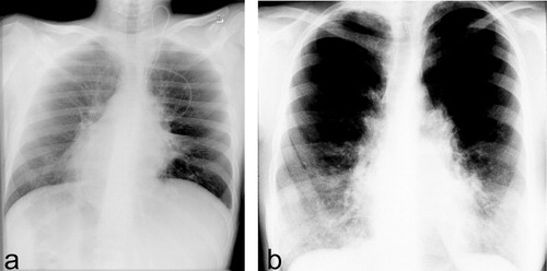 Figure 2 Clinical findings in PCD subjects.a. Radiograph of chest shows dextrocardia in a patient with situs inversus. Note also pulmonary dystelectasis and infiltrates. b. Chest radiograph of an adult PCD patient with chronic airway disease and bronchiectasis.