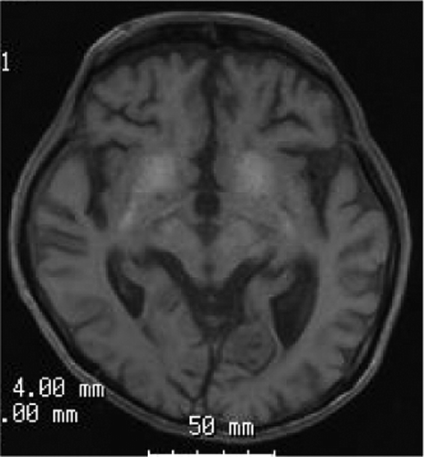 Figure 2. Brain magnetic resonance imaging scans with T1 weighed images. Diffuse cortical atrophy and calcification of the basal ganglia were detected.