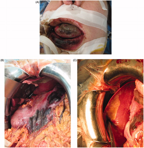 Figure 2. (a) Caustic soda (sodium hydroxide) ingestion. Lips and tongue injuries. (b) At emergent surgery, necrosis of the anterior stomach wall with perforations. (c) At emergent surgery, duodenal edema and injury of segment II of the liver.