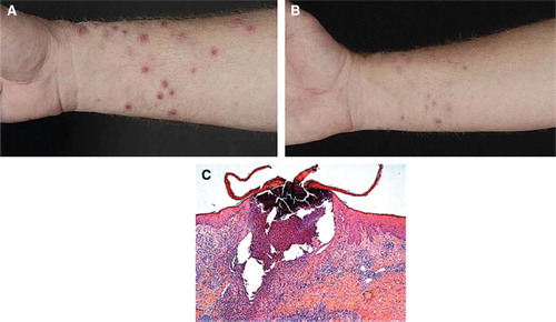 Figure 1. Patient 1: (A) Severe purulent perforating bacterial folliculitis, with an atypical distribution as compared to the acneiform eruption seen in patients with an EGFR-inhibitor (left panel). (B) Recovery of acneiform eruptions after treatment with oral minocyclin 100 mg once daily (mid panel). (C) Histopathology of one of the lesions, showing an acanthotic epidermis with diffuse hyperkeratosis, a enlarged ruptured follicle with a massive influx of an inflammatory infiltrate mainly consisting of neutrophils. (Magnification 100′)