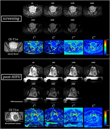 Figure 2. Diffusion weighted imaging (DWI) b-value images (first two rows) and IVIM perfusion fraction maps (lower rows) of a uterine fibroid before and after MR-HIFU treatment, generated using conventional least squares (flq) and neural net (fnn) fitting techniques, and a T2-uncorrected (f) and T2-corrected (fc) IVIM model. Based on the contrast enhanced-T1w (CE-T1w) scan, the fibroid’s perfusion has been successfully eliminated in this patient. This seems to be accurately reflected on the post-HIFU perfusion fraction maps, as perfusion fraction is decreased within the fibroid in comparison to screening. The HIFU-transducer, which is located in an oil tank, is visible in the post-HIFU DWI and perfusion fraction maps and marked in the post-HIFU b0 DWI image. During treatment, the patient lies prone on a membrane on top of the transducer.