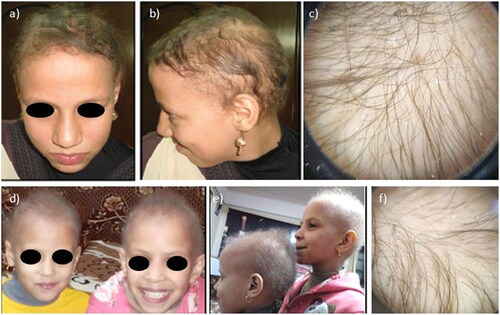 Figure 1. Clinical and dermoscopic picture of the affected patients and her cousins. (a,b,d,e) patients presented with thinning of scalp hair which is non growing since birth, (c,f) scalp dermoscopy showing normal hair shaft with variation in hair thickness and lowered density.