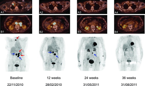 Figure 3  (Top) Axial sections of total body 18FDG-PET/CT scans in Patient C. Views A1 and B1 show 18FDG-avid right retroclavicular and retroperitoneal lymph node metastases. (Bottom) Corresponding coronal maximal-intensity-projection PET images at baseline and subsequent assessments. Baseline scan shows 18FDG-avid right retroclavicular and retroperitoneal lymph node metastases. At 12 weeks after starting treatment with ipilimumab 3 mg/kg, scan showed normalization of both the retroclavicular lesion and two out of four retroperitoneal lymph node metastases (red arrows) with simultaneous growth of the other two retroperitoneal lymph node metastases (blue arrows). At Week 24, there was a regression of all lymph node metastases, resulting in a CR at Week 36.
