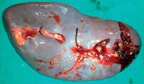 Figure 1. Lacerated spleen with haemorrhages.