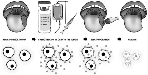 Figure 1. Electrochemotherapy on head and neck tumors.