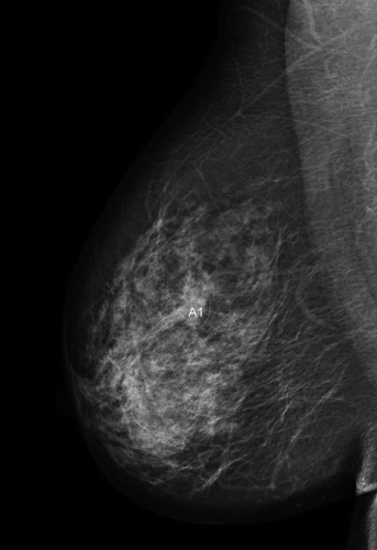 Figure 1. The mammography identified a tumour at 1 o´clock 6 cm from the papillary complex in the right breast.