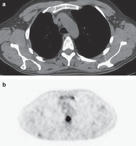 Figure 2. Comparison between normal CT image (a) and PET/CT which demonstrates abnormal uptake in the sternum and in thoracic vertebrae (b).
