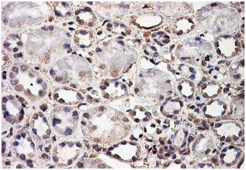 Figure 2. Positive αSMA immunostaining in the cytoplasm and nuclei of tubular epithelial structures. αSMA stain LSAB2-DAB × 200.