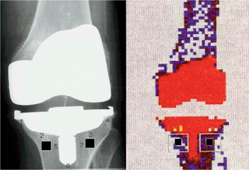 Figure 1. Definition of ROI-1 and ROI-2 in radiographs and DXA scans.