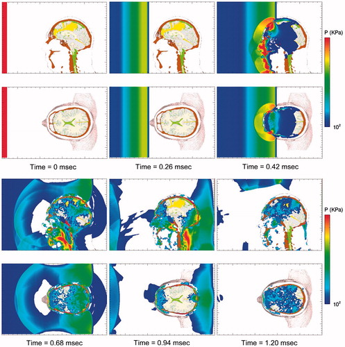 Figure 5. Time-lapse images of frontal blast exposure showing pressure in the mid-sagittal and supraorbital axial planes of the head-neck model. Upper pressure limit is 500 KPa. Regions without color are at or below the threshold pressure of 100 KPa (1 bar).
