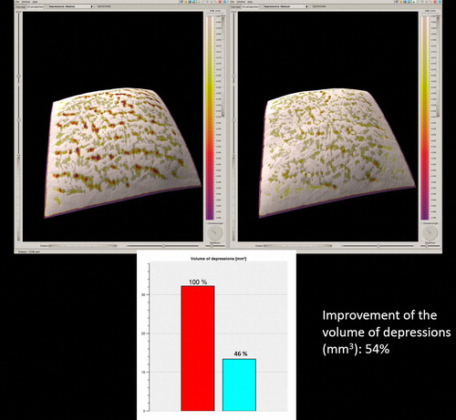 Figure 6. The 3D skin surface analysis of the 22 year-old, ST III female depicted in Figure 5, before the treatment (left) and 3 months after the end of treatment (right).