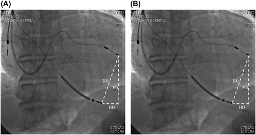 Figure 2. Interlead distance measured as DD, HD and VD on posteroanterior (A) and left lateral (B) fluoroscopy views.