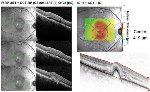 Figure 2 Spectral domain-optical coherence tomography of a right eye affected by age-related macular degeneration (AMD). Macular neuroepthelial detachment (central thickness of 419 µm) and choroidal neovascular membrane (CNV).