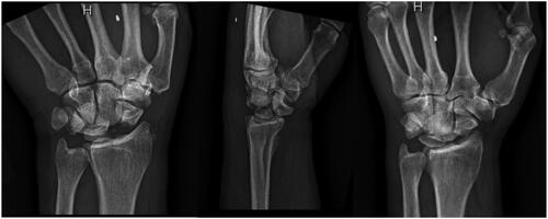 Figure 1. Initial presentation of the patient’s left trans-scaphoid lunate dislocation. The classic ‘spilled teacup’ sign can be seen on the lateral view.