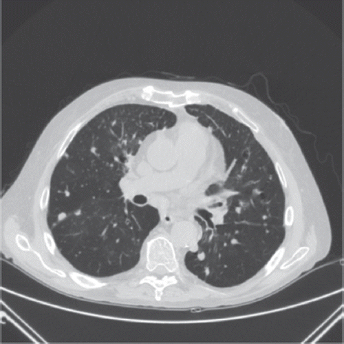 Figure 1. CT-scan of the thorax.