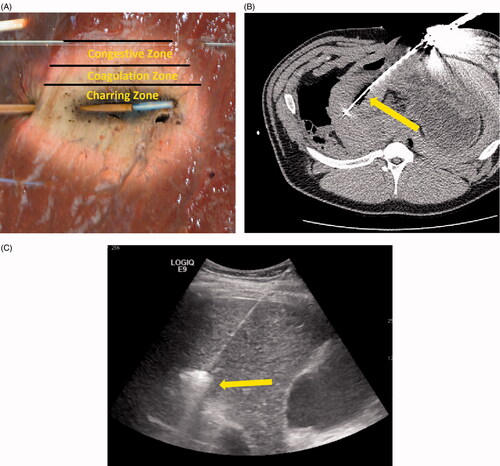 Figure 4. (A) Microwave ablation created in ex vivo liver tissue. The charred zone is the darkened area at the centre of the ablation zone which was highly desiccated from the intense heat and water vaporisation (>100 °C). The coagulation zone is the blanched region of the ablation zone, usually showing pyknotic nuclei on histology (70–100 °C). The congestive zone is the red peripheral area of the ablation zone that represents the boundary of the ablation zone and is sometimes called the transition zone (50–70 °C). (B) Intra-procedural imaging of a monopole antenna during an in vivo ablation procedure. The central hypo-dense zone identifies water vaporisation. (C) Gas bubbles resulting from water vaporisation are visible on ultrasound imaging and can be used to monitor treatment progress.