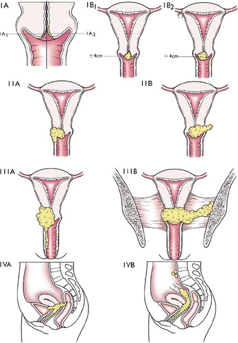 Figure 3. Staging of cervical cancer according to FIGO (Montreal, 1994) extracted from [Citation44].