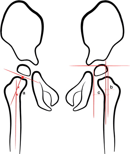 Figure 1. Measurement of the head-shaft angle (HSA), shown as a on the right hip, and the migration percentage (MP), calculated as b/c × 100, on the left hip.