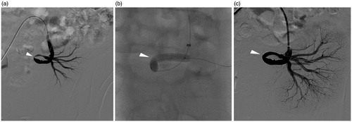 Figure 1. (a–c) An 18-year-old male with elevated serum creatinine level and uncontrolled hypertension 3 months post-operatively. (a) Angiography showed about 80% stenosis (arrowhead) at the anastomosis of transplant renal artery. (b) Balloon was dilated until no “waist-sign” (arrowhead) was left. (c) Subsequent angiography showed almost no residual stenosis (arrowhead).